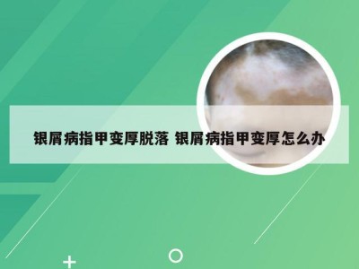 银屑病指甲变厚脱落 银屑病指甲变厚怎么办