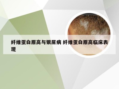 纤维蛋白原高与银屑病 纤维蛋白原高临床表现