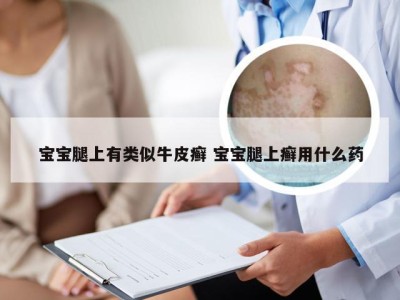 宝宝腿上有类似牛皮癣 宝宝腿上癣用什么药