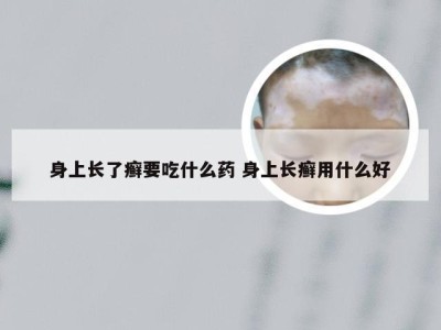 身上长了癣要吃什么药 身上长癣用什么好