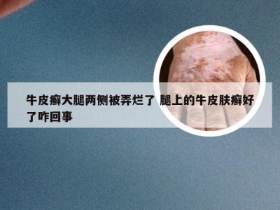 牛皮癣大腿两侧被弄烂了 腿上的牛皮肤癣好了咋回事