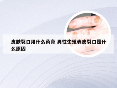 皮肤裂口用什么药膏 男性生殖表皮裂口是什么原因