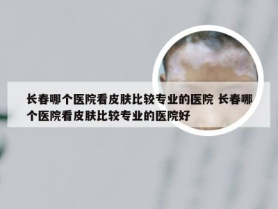 长春哪个医院看皮肤比较专业的医院 长春哪个医院看皮肤比较专业的医院好