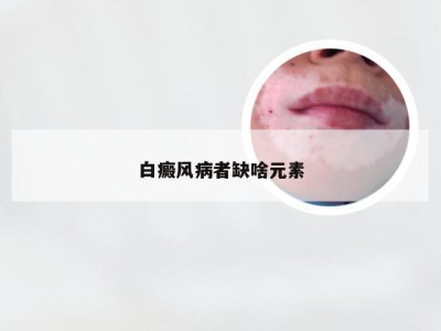 白癜风病者缺啥元素