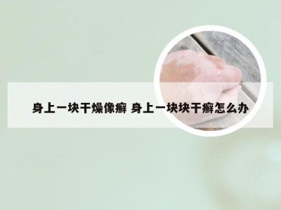 身上一块干燥像癣 身上一块块干癣怎么办