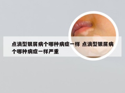 点滴型银屑病个哪种病症一样 点滴型银屑病个哪种病症一样严重