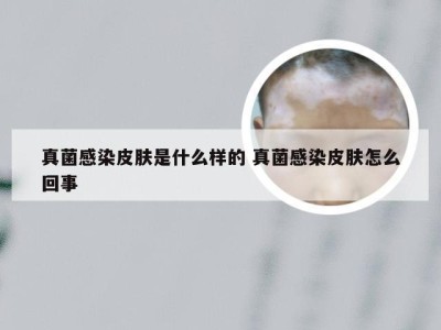 真菌感染皮肤是什么样的 真菌感染皮肤怎么回事