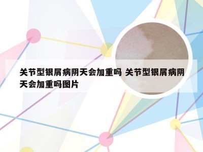 关节型银屑病阴天会加重吗 关节型银屑病阴天会加重吗图片