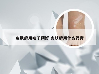 皮肤癣用啥子药好 皮肤癣用什么药膏