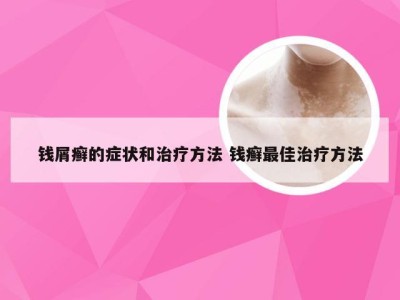 钱屑癣的症状和治疗方法 钱癣最佳治疗方法