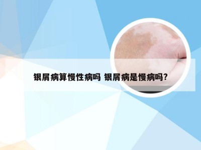 银屑病算慢性病吗 银屑病是慢病吗?