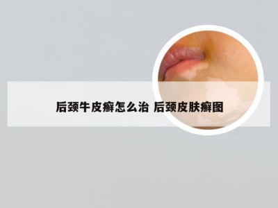 后颈牛皮癣怎么治 后颈皮肤癣图