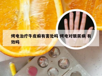 烤电治疗牛皮癣有害处吗 烤电对银屑病 有效吗