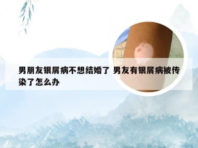 男朋友银屑病不想结婚了 男友有银屑病被传染了怎么办