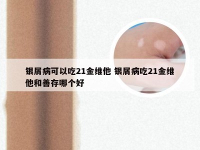 银屑病可以吃21金维他 银屑病吃21金维他和善存哪个好