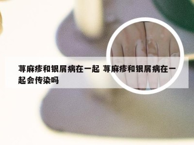 荨麻疹和银屑病在一起 荨麻疹和银屑病在一起会传染吗