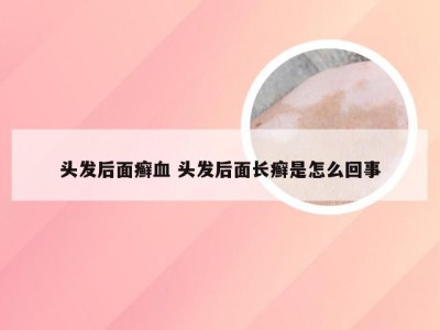 头发后面癣血 头发后面长癣是怎么回事