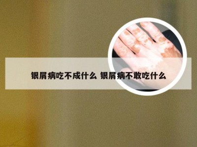 银屑病吃不成什么 银屑病不敢吃什么