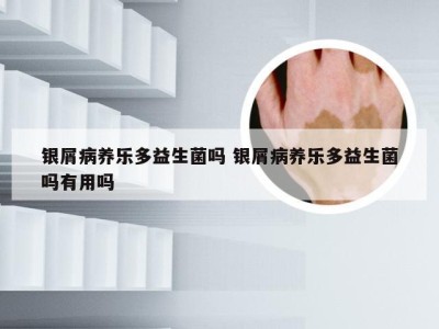 银屑病养乐多益生菌吗 银屑病养乐多益生菌吗有用吗