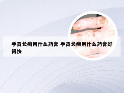 手背长癣用什么药膏 手背长癣用什么药膏好得快