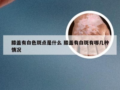 膝盖有白色斑点是什么 膝盖有白斑有哪几种情况