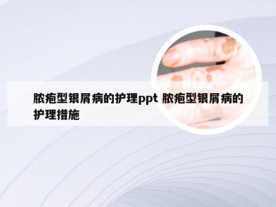 脓疱型银屑病的护理ppt 脓疱型银屑病的护理措施