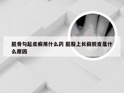 屁骨勾起皮癣用什么药 屁股上长藓脱皮是什么原因