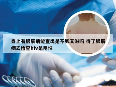 身上有银屑病能查出是不钱艾滋吗 得了银屑病去检查hiv是阴性