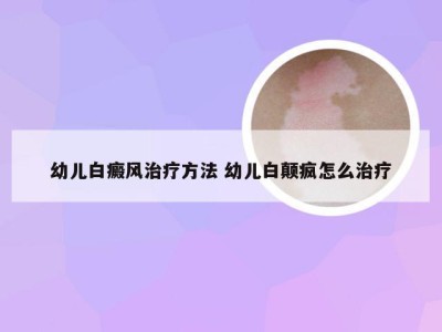 幼儿白癜风治疗方法 幼儿白颠疯怎么治疗