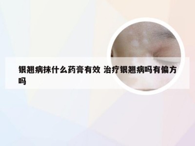 银翘病抹什么药膏有效 治疗银翘病吗有偏方吗