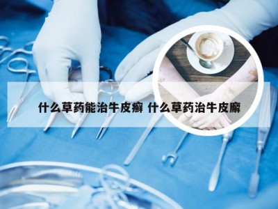 什么草药能治牛皮癣 什么草药治牛皮廨