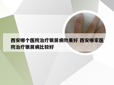 西安哪个医院治疗银屑病效果好 西安哪家医院治疗银屑病比较好