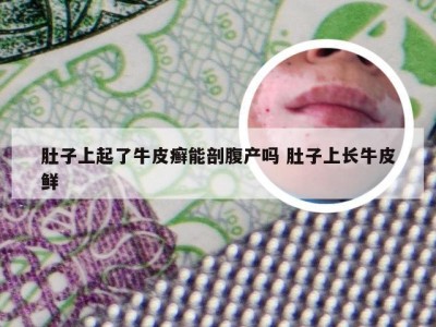 肚子上起了牛皮癣能剖腹产吗 肚子上长牛皮鲜