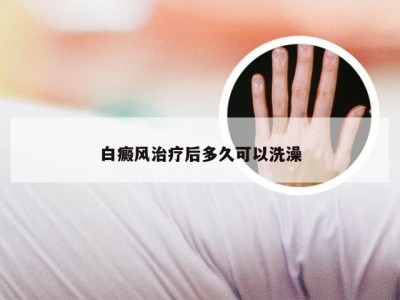 白癜风治疗后多久可以洗澡