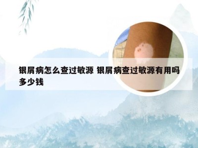 银屑病怎么查过敏源 银屑病查过敏源有用吗多少钱