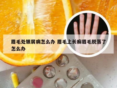 眉毛处银屑病怎么办 眉毛上长癣眉毛脱落了怎么办