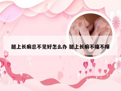 腿上长癣总不见好怎么办 腿上长癣不痛不痒