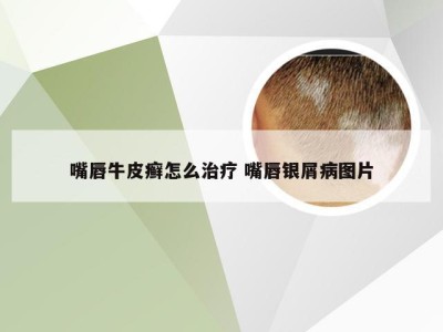 嘴唇牛皮癣怎么治疗 嘴唇银屑病图片