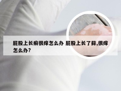 屁股上长癣很痒怎么办 屁股上长了藓,很痒怎么办?