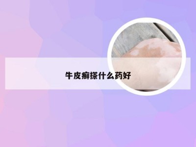 牛皮癣搽什么药好