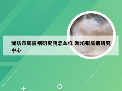 潍坊市银屑病研究院怎么样 潍坊银屑病研究中心