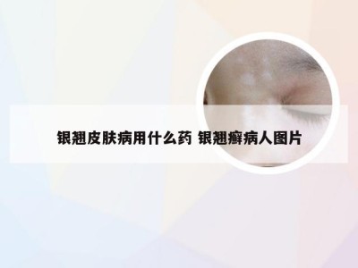 银翘皮肤病用什么药 银翘癣病人图片