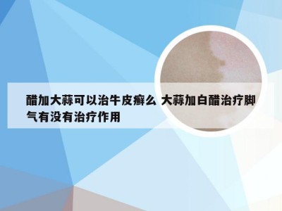 醋加大蒜可以治牛皮癣么 大蒜加白醋治疗脚气有没有治疗作用