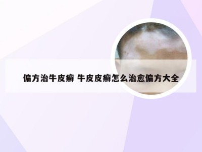 偏方治牛皮癣 牛皮皮癣怎么治愈偏方大全