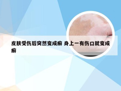 皮肤受伤后突然变成癣 身上一有伤口就变成癣