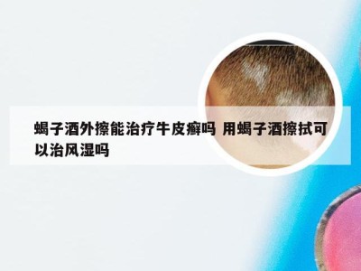 蝎子酒外擦能治疗牛皮癣吗 用蝎子酒擦拭可以治风湿吗