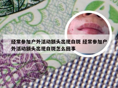 经常参加户外活动额头出现白斑 经常参加户外活动额头出现白斑怎么回事