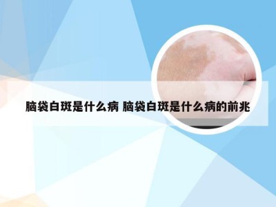 脑袋白斑是什么病 脑袋白斑是什么病的前兆