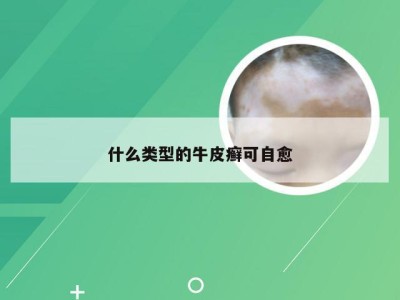 什么类型的牛皮癣可自愈