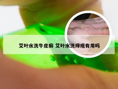 艾叶水洗牛皮癣 艾叶水洗痔疮有用吗